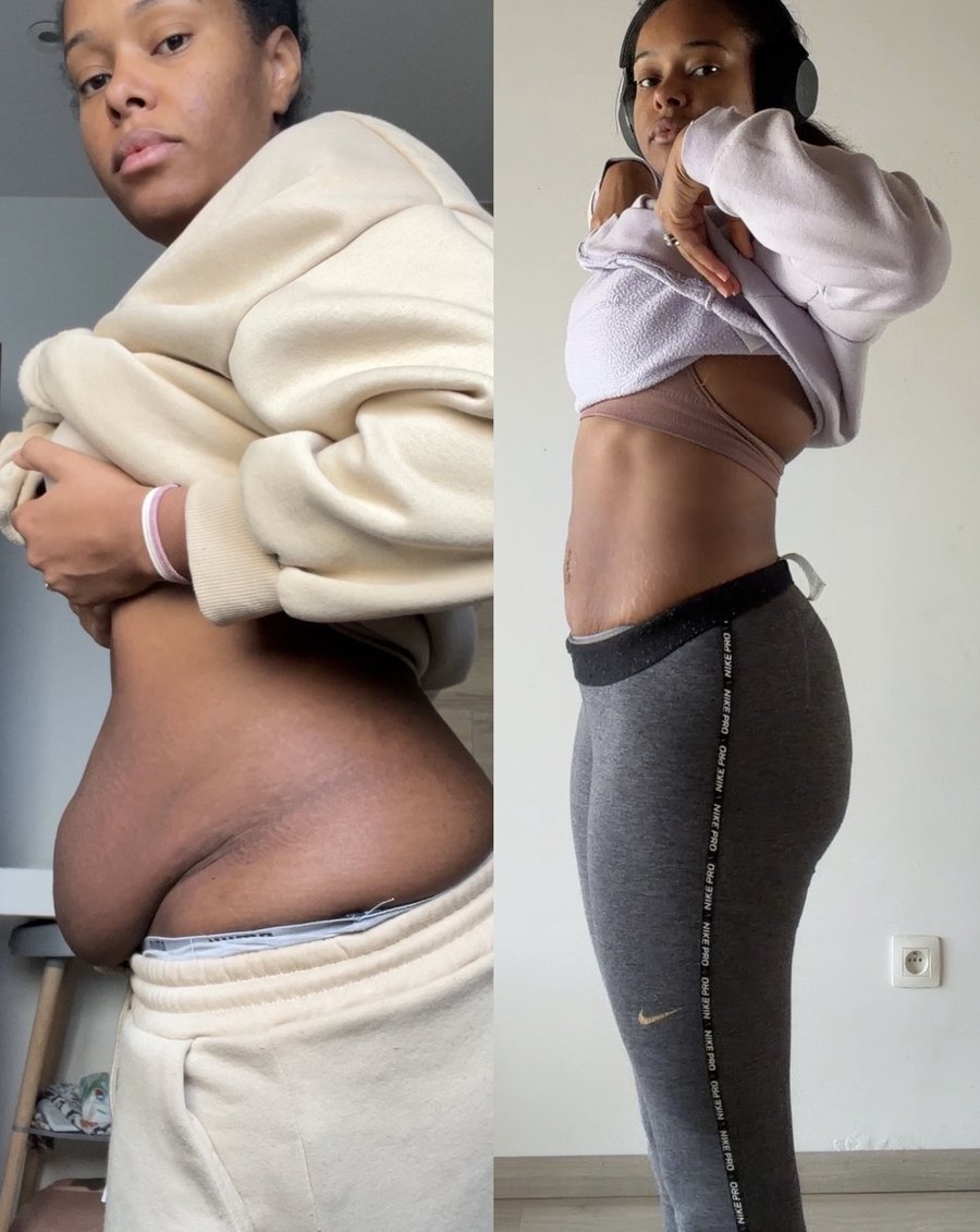 Transformation avant après diastasis, réduction du ventre après grossesse